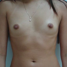 Breast Augmentation Before