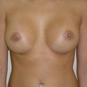 Breast Augmentation After