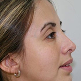 Rhinoplasty After