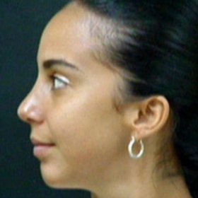 Rhinoplasty After