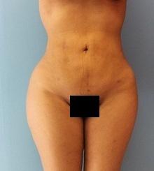 after Body Sculpting 1
