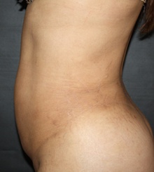 after Body Sculpting 12