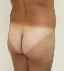 before Brazilian Butt Lift 17