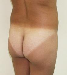 before Brazilian Butt Lift 17