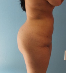 after Brazilian Butt Lift 4