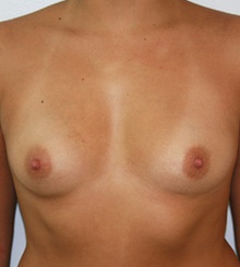 before Breast Augmentation 28