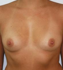 before Breast Augmentation 28