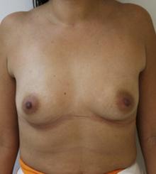 before Breast Augmentation 18