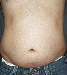 before Body Sculpting 5