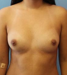 before Breast Augmentation 4