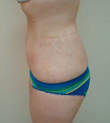 after Body Sculpting 10