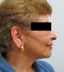 after Face Lift 1