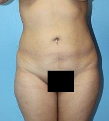before Body Sculpting 1