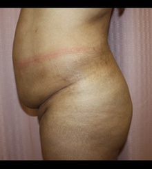 before Brazilian Butt Lift 12