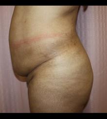 before Brazilian Butt Lift 12