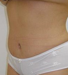 after Tummy Tuck 1