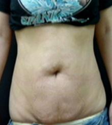 before Tummy Tuck 17