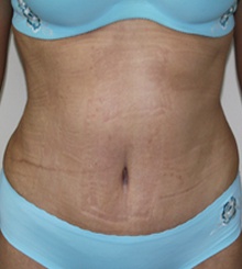 after Tummy Tuck 16