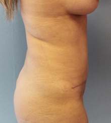 after Tummy Tuck 14