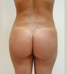 after Brazilian Butt Lift 6