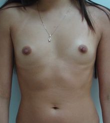 before Breast Augmentation 2