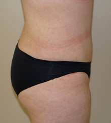 after Tummy Tuck 3