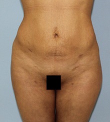 after Body Sculpting 8