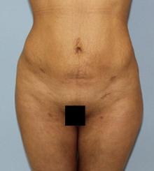 after Body Sculpting 8