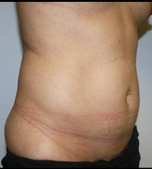 before Body Sculpting 3