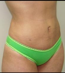 after Body Sculpting 3