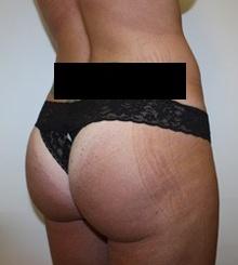 after Brazilian Butt Lift 7