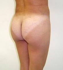 after Brazilian Butt Lift 10