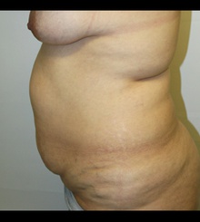 before Tummy Tuck 5
