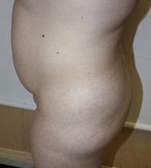 before Brazilian Butt Lift 28