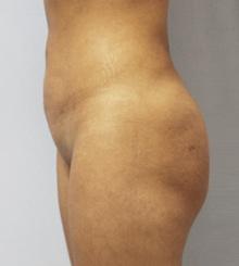 after Brazilian Butt Lift 19