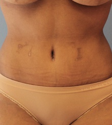 after Tummy Tuck 23