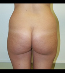 before Brazilian Butt Lift 9