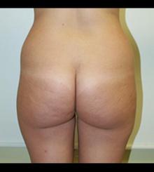 before Brazilian Butt Lift 9