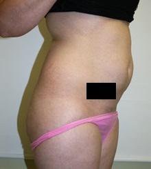 before Brazilian Butt Lift 11
