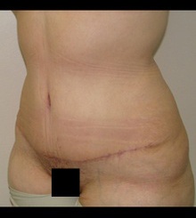 after Tummy Tuck 5