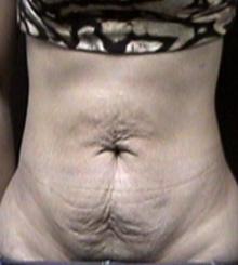before Tummy Tuck 2