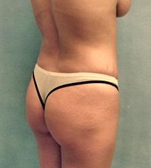 before Brazilian Butt Lift 6