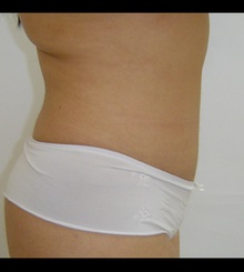 after Tummy Tuck 12