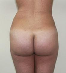 after Brazilian Butt Lift 16