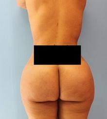 after Brazilian Butt Lift 5