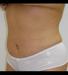 after Tummy Tuck 12