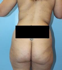 before Brazilian Butt Lift 5