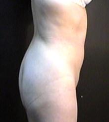 before Brazilian Butt Lift 3