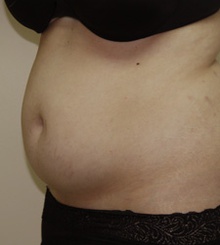 before Body Sculpting 10