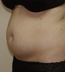before Body Sculpting 10